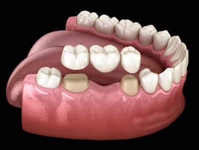 image of a dental bridge in maple grove mn