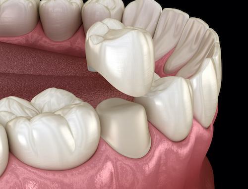 image of a dental crown in maple grove mn