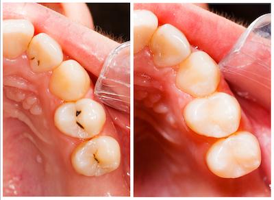 tooth filling in maple grove mn