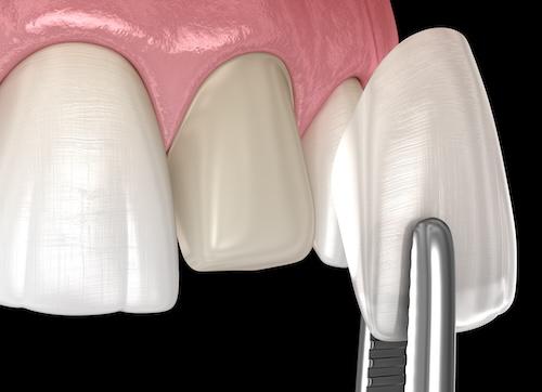 image of a porcelain veneer in maple grove