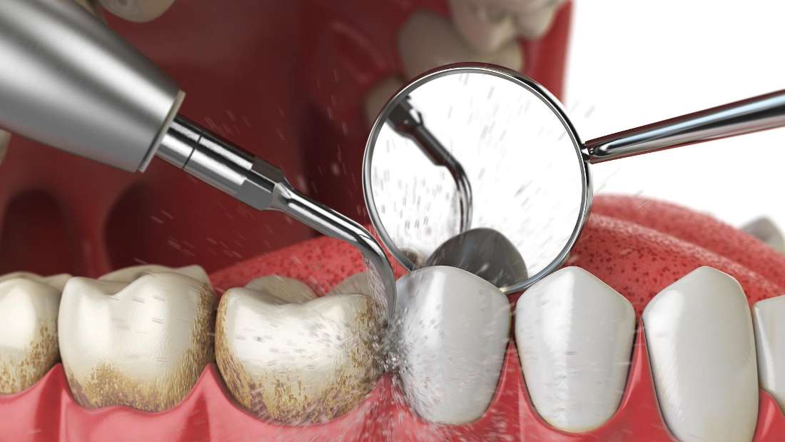 image a of a teeth cleaning in maple grove mn