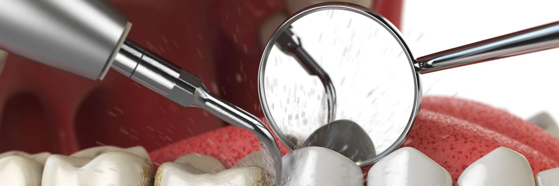 image of a teeth cleaning in maple grove mn
