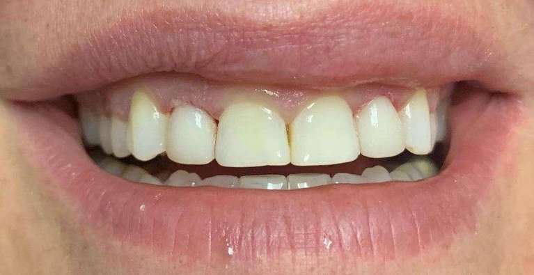 Dental-Bonding-After-Image