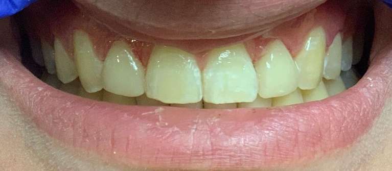 Cosmetic-Bonding-After-Image