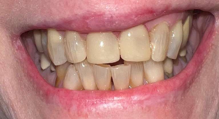 after dental bonding in maple grove mn