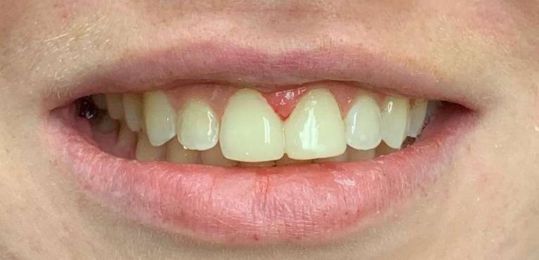 after cosmetic dental bonding in maple grove