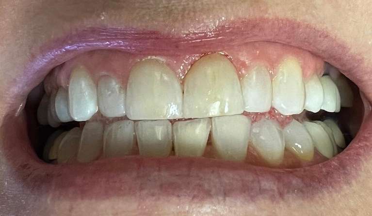 Cosmetic-Bonding-After-Image