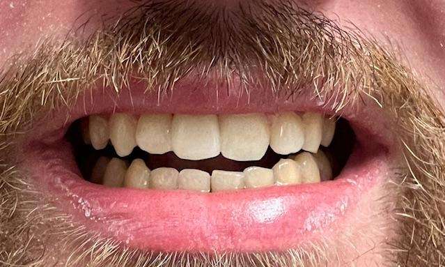 Dental-Implant-After-Image