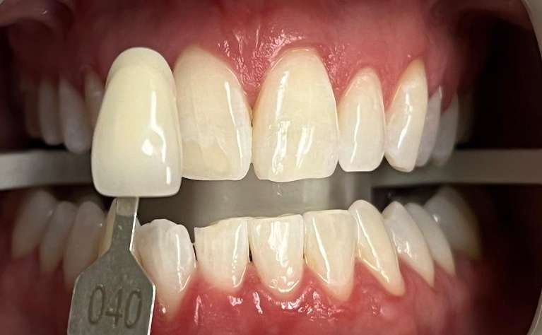 after zoom teeth whitening in maple grove