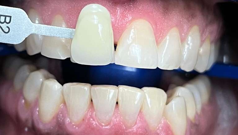 after professional teeth whitening in maple grove mn