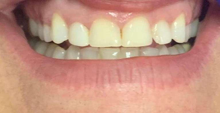 Dental-Bonding-Before-Image