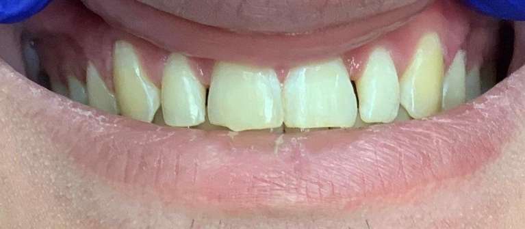 Cosmetic-Bonding-Before-Image