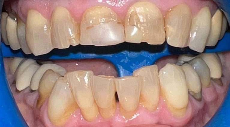 before cosmetic bonding maple grove mn