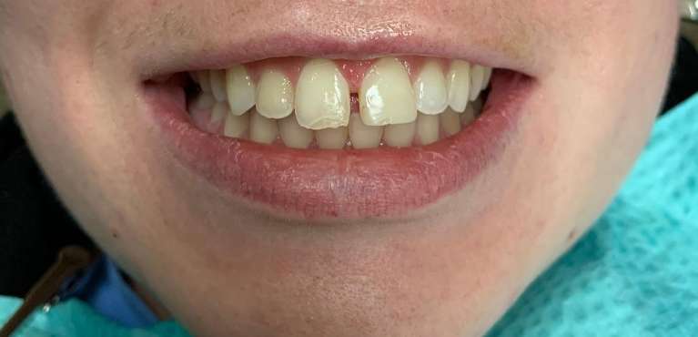 before tooth bonding in maple grove mn