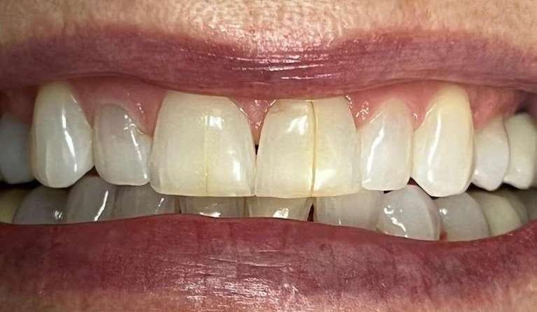 Cosmetic-Bonding-Before-Image