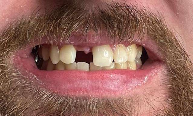 Dental-Implant-Before-Image