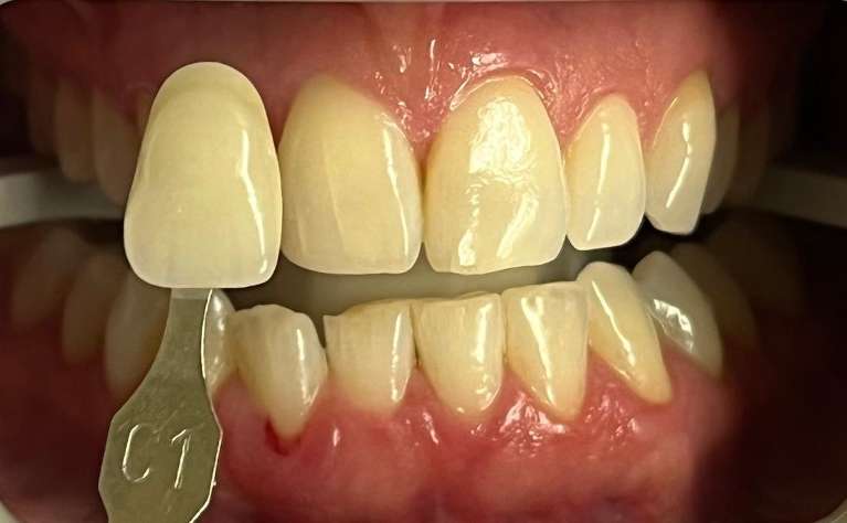 before zoom teeth whitening in maple grove mn