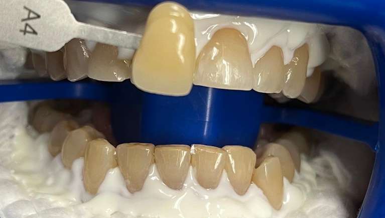 before professional teeth whitening in maple grove