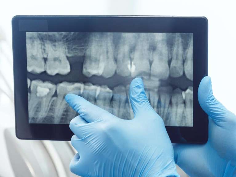 digital dental x-rays in maple grove