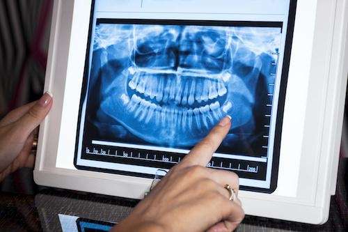 panoramic dental x-rays in maple grove mn